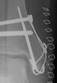 Ankle Fracture Medial Malleolus TBW